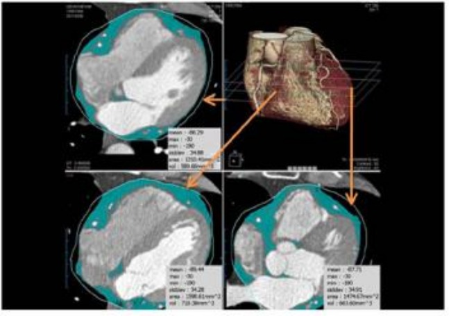 ▲다중체널 CT를 이용한 심장주위지방 측정 방법(초록색이 지방)이다. 